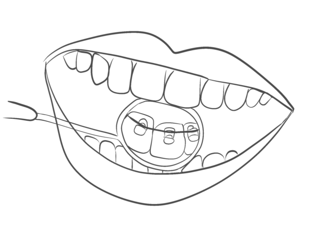 Lingual braces Illustration