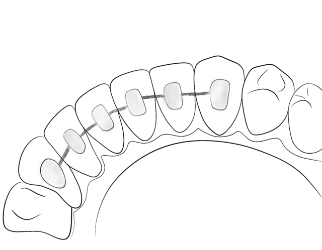 Care of the unique braces system Illustration