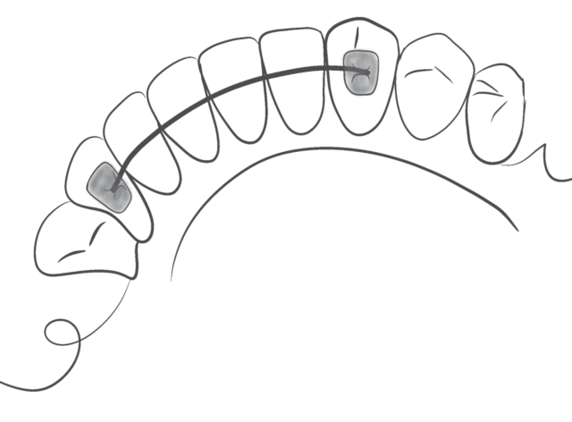 Tips for wearing retainers: Illustration