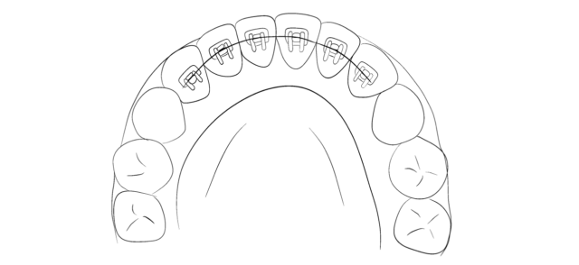 A breakdown of Lingual Brace Design Illustration