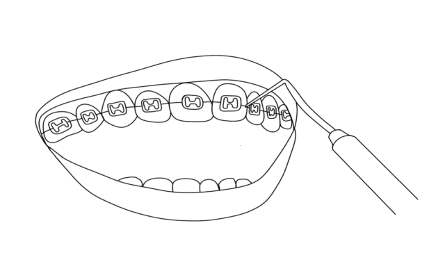 Placement Process Illustration