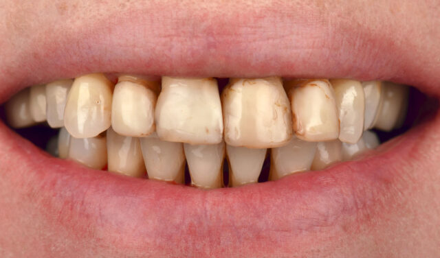 Complex Rehabilitation: A Patient with Stage 4 Periodontitis