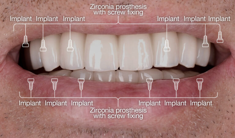 Implantation and prosthetics of a patient with extensive tooth decay in the upper jaw