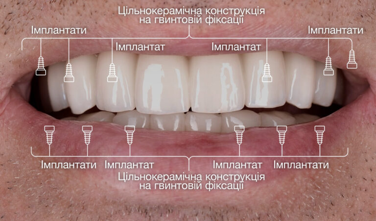 Імплантація та протезування пацієнта з множинним ускладненим карієсом на верхній щелепі