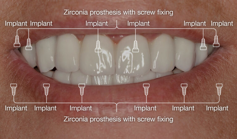 Implant treatment to a patient with significant tooth loss due to severe caries