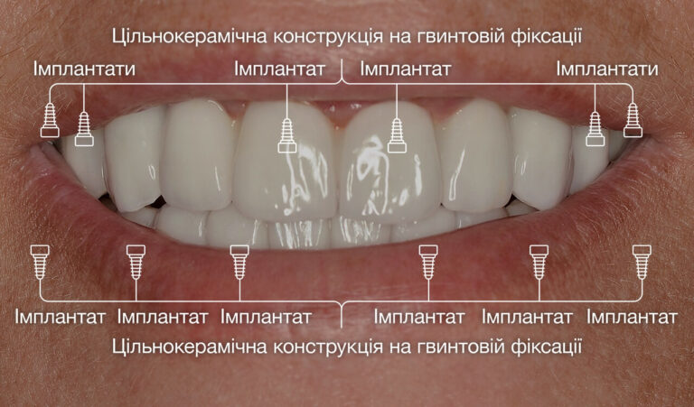 Імплантологічне лікування зі значною втратою зубів внаслідок ускладненого карієсу