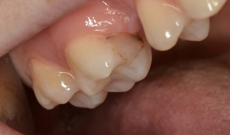 Photopolymer Filling. Photo before