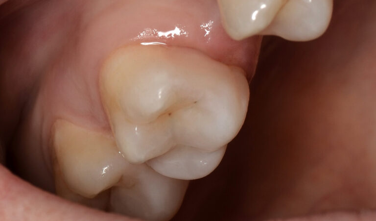 Photopolymer Filling. Photo after