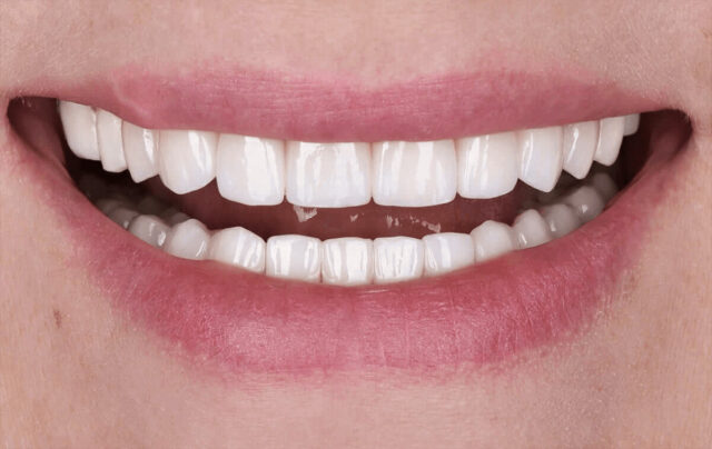 Rehabilitation of a patient with tooth wear using ceramic restorations