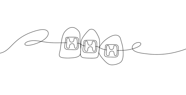 What are self-ligating braces? Illustration