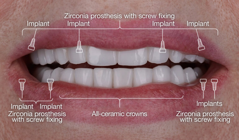Tooth Extraction with Extensive Caries under Fused Porcelain Crown Reconstruction of both jaws with zirconium implant-supported restoration