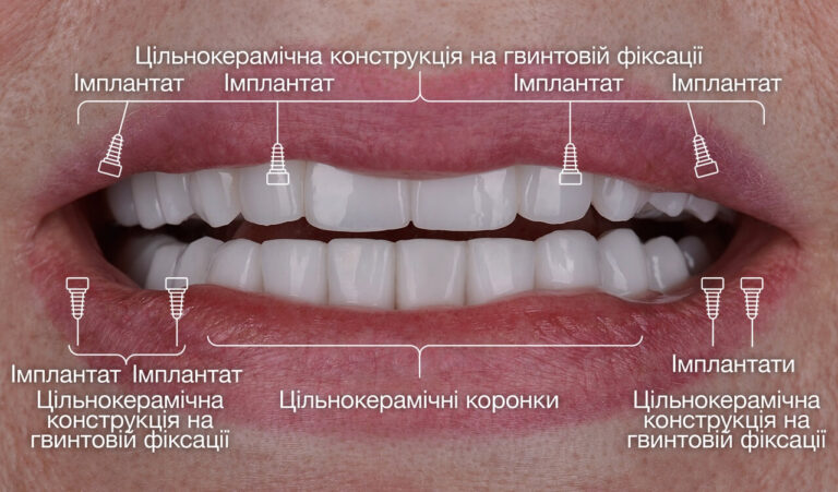 Видалення зубів з ускладненим карієсом