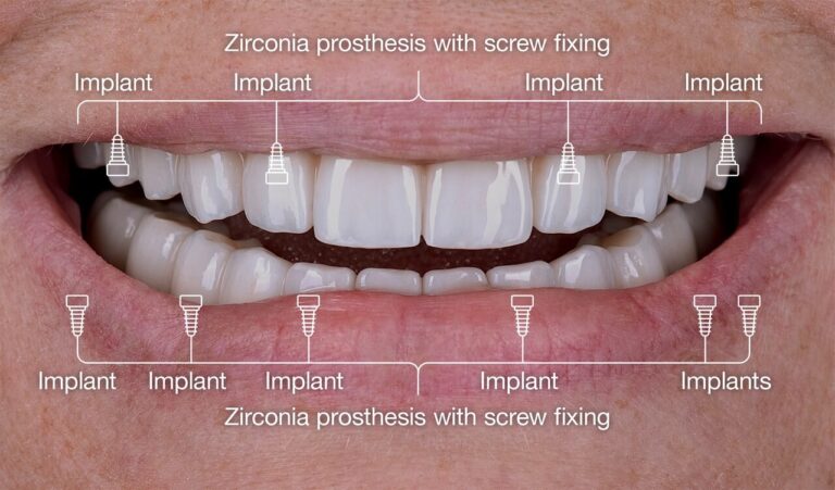 Implant Treatment in a Patient with Severe Periodontitis