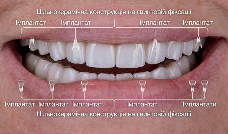 Імплантологічне лікування пацієнта з тяжкою формою пародонтиту
