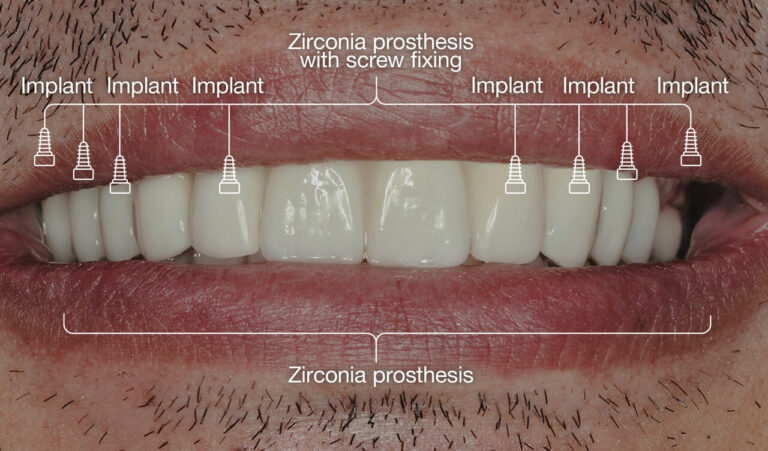 Implantological treatment of a patient with extensive tooth decay and deep traumatic overbite