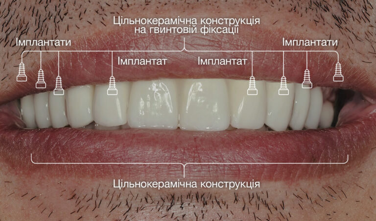 Корекція травмувальної оклюзії та імплантологічне лікування при глибокому травмувальному прикусі