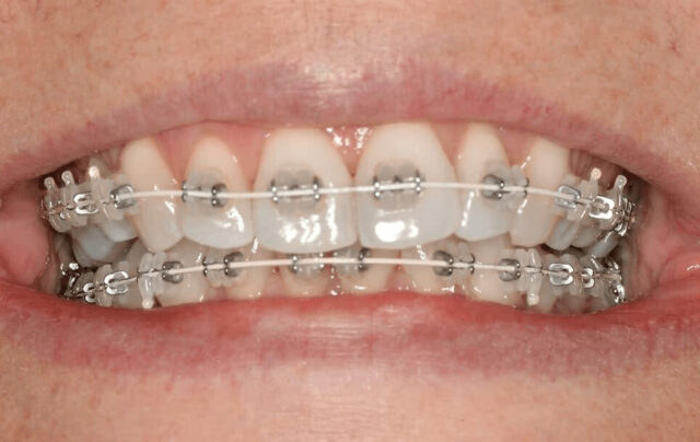 Braces care