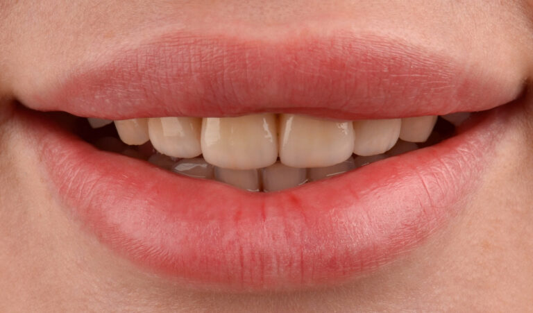 Replacement of ceramic veneers