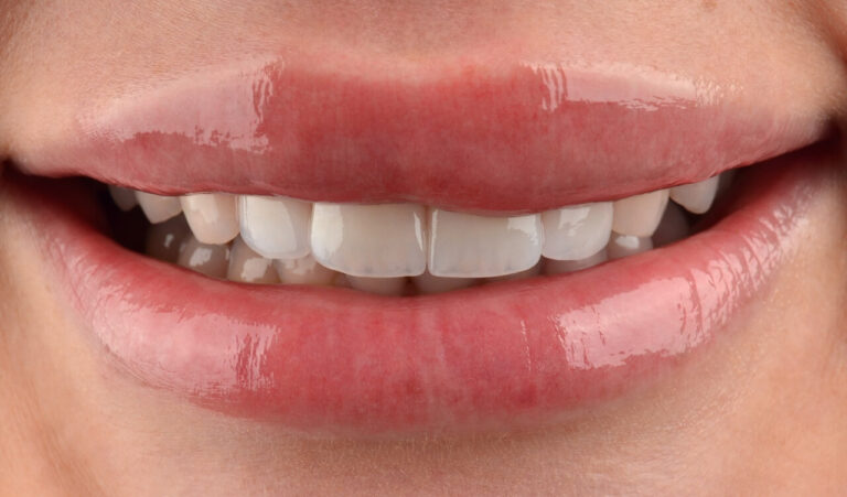 Replacement of ceramic veneers