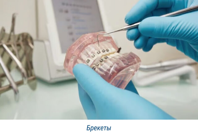 Брекеты