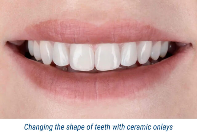 Changing the shape of teeth with ceramic onlays