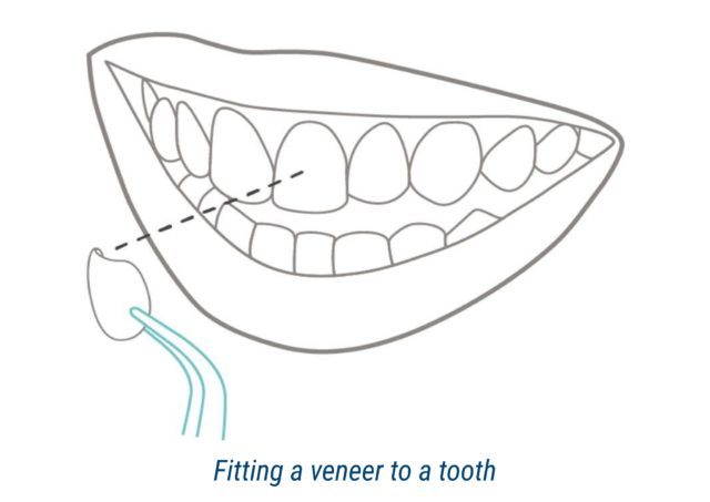 Fitting a veneer to a tooth