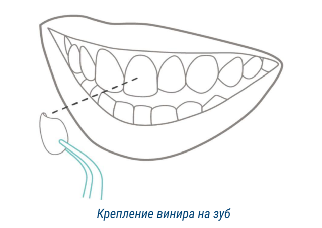 Крепление винира на зуб