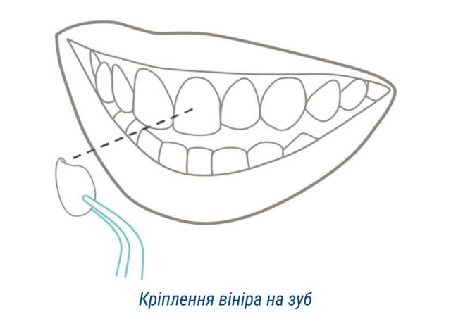 Кріплення вініра на зуб