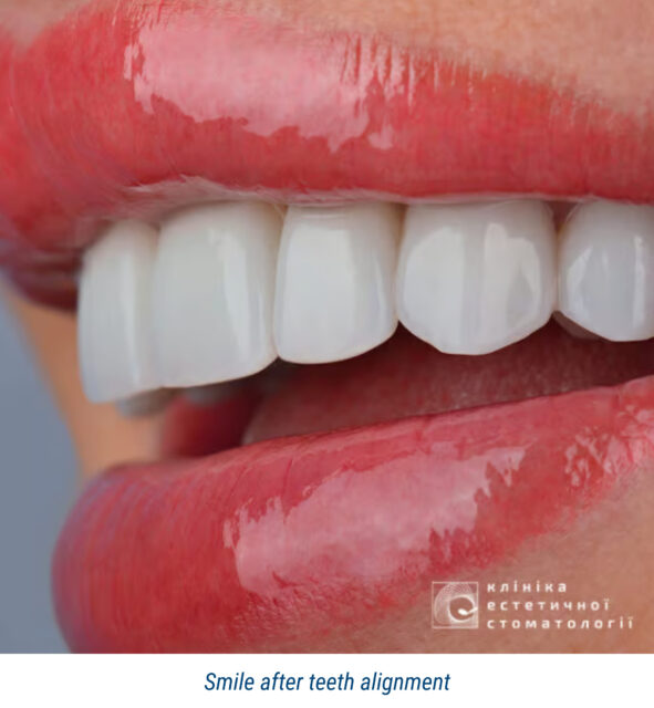 Smile after teeth alignment