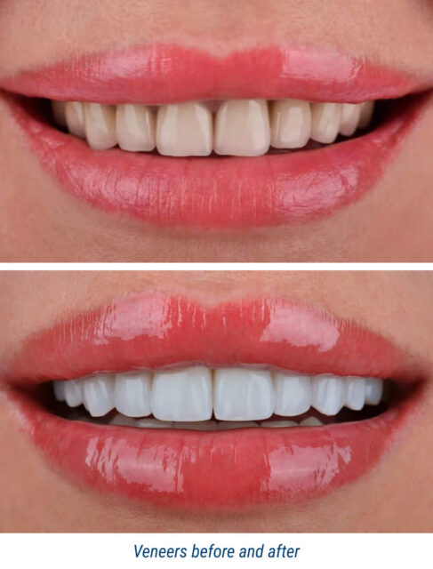Veneers before and after