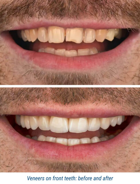 Veneers on front teeth: before and after