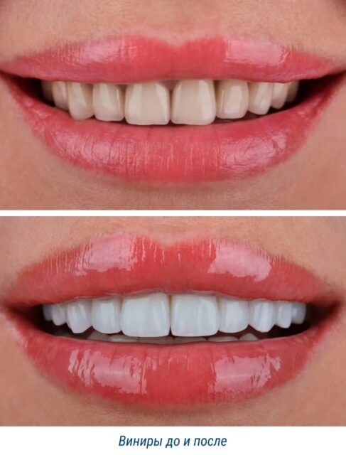 Виниры до и после