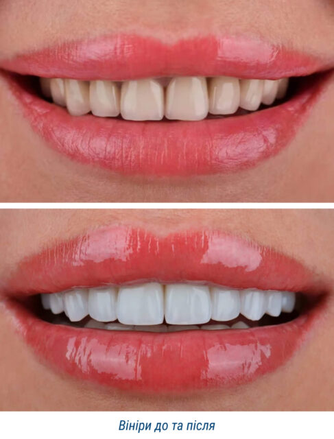 Вініри до та після