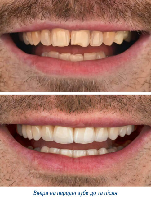 Вініри на передні зуби до та після
