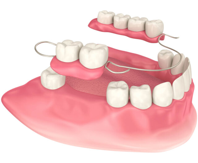 What are Complete Dentures, Removable Partial Dentures, and Bridges? Illustration