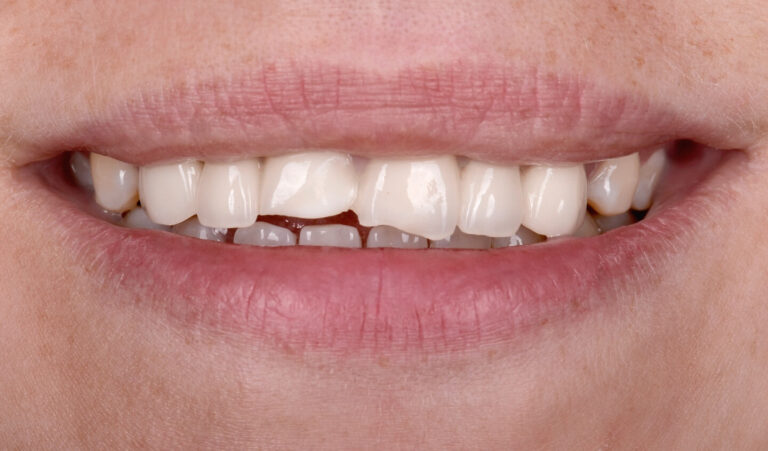 Composite veneers vs ceramic veneers. Photo before