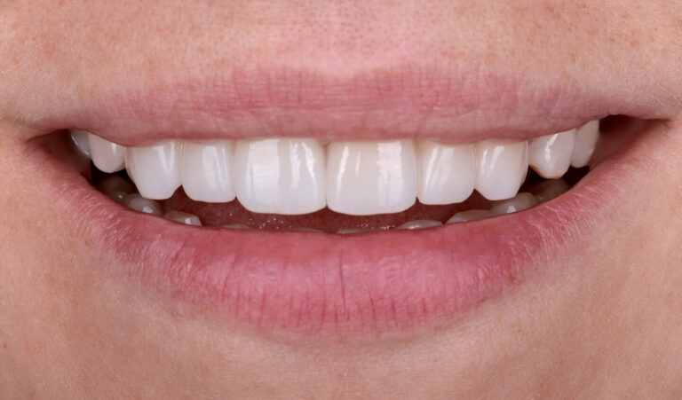 Composite veneers vs ceramic veneers. Photo after
