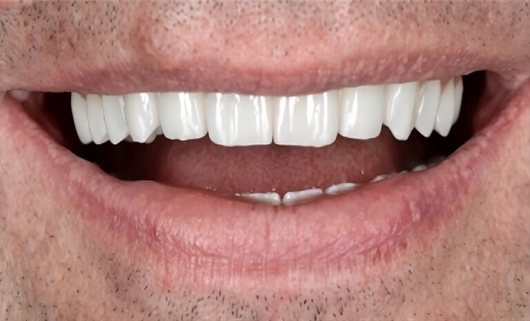 How Removable Dentures Are Attached. Photo after