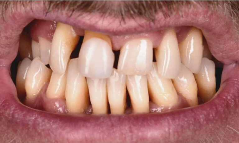 What are dental prosthetics?. Photo before