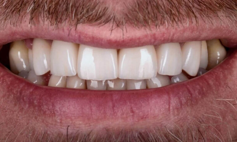 What are dental prosthetics?. Photo after