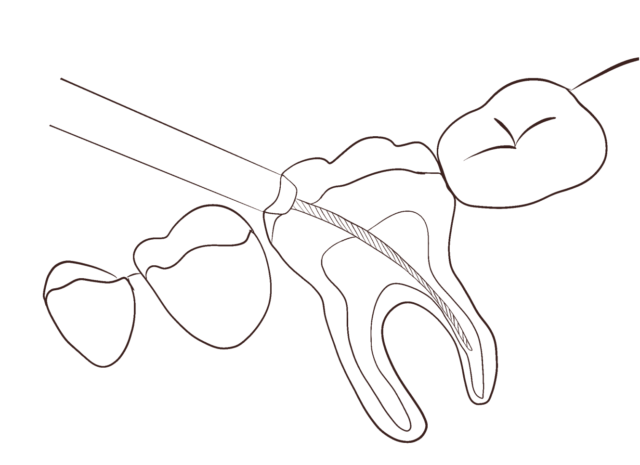 What is dental filling? Illustration