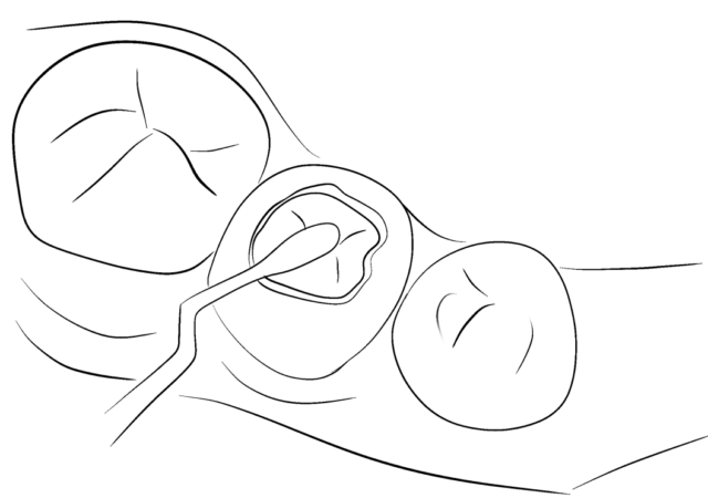 The lifespan of dental fillings Illustration