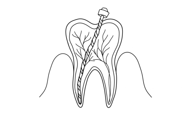 Pulpitis Illustration