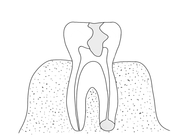 What is granuloma treatment? Illustration
