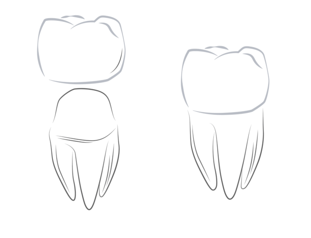 The process of installing dental crowns Illustration