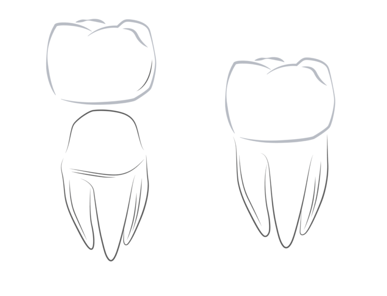 tooth-crown+inlay-02 1