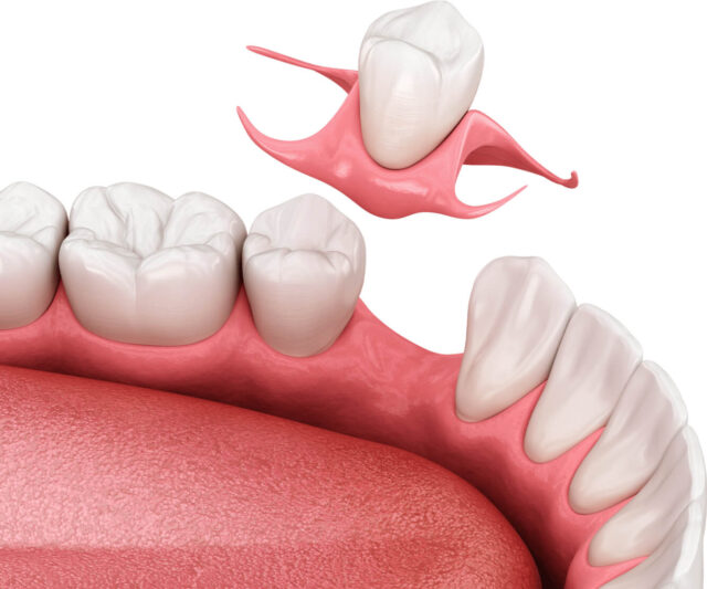 Immediate dentures Illustration