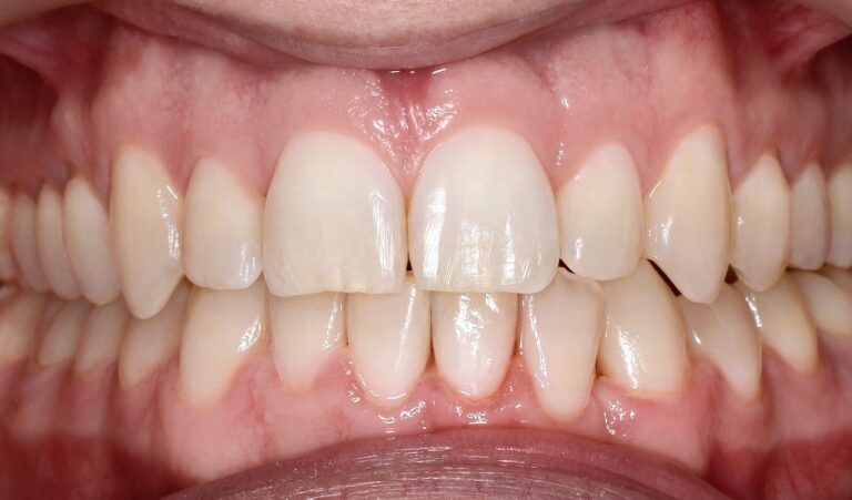 Advantages of metal braces. Photo after
