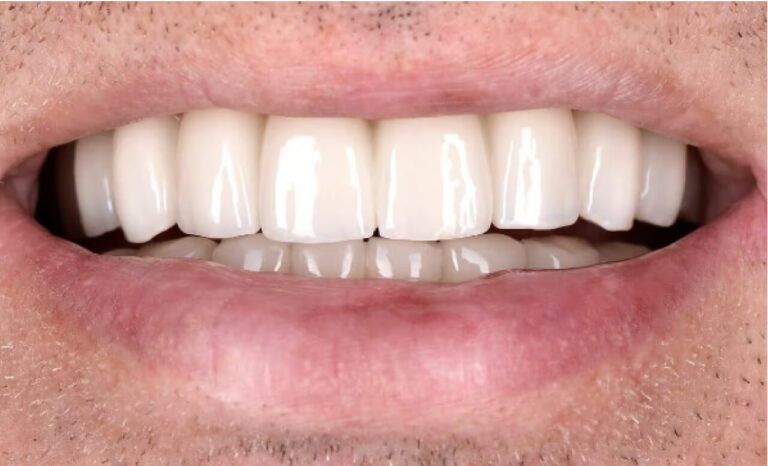 Lamellar dentures. Photo after