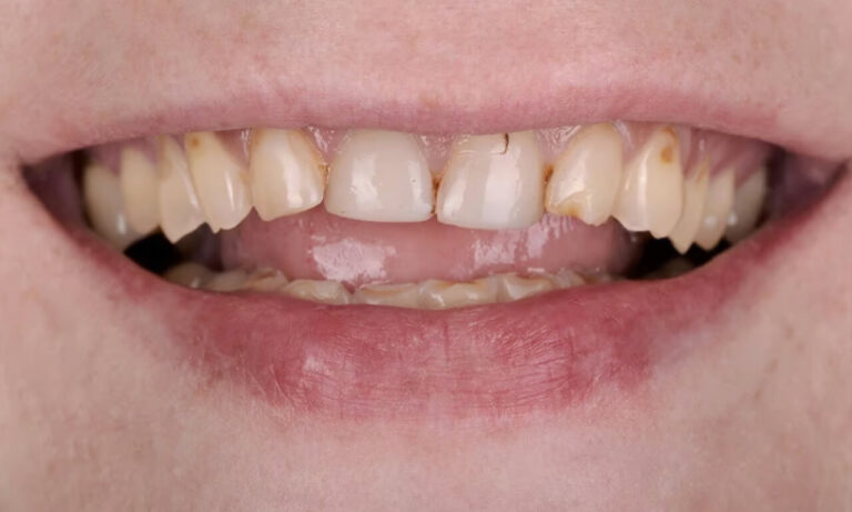What are the features of all-ceramic crowns?. Photo before